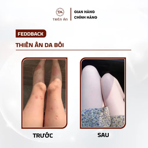 Kem Bôi Da Thiên Ân 20gr - Hình ảnh 6