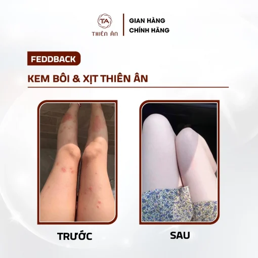 [Combo 2] Kem Bôi Da + Xịt Thiên Ân - Hình ảnh 6