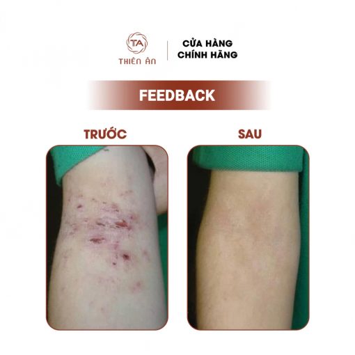 Feedback của khách hàng về Lọ xịt trị da liễu Thiên Ân