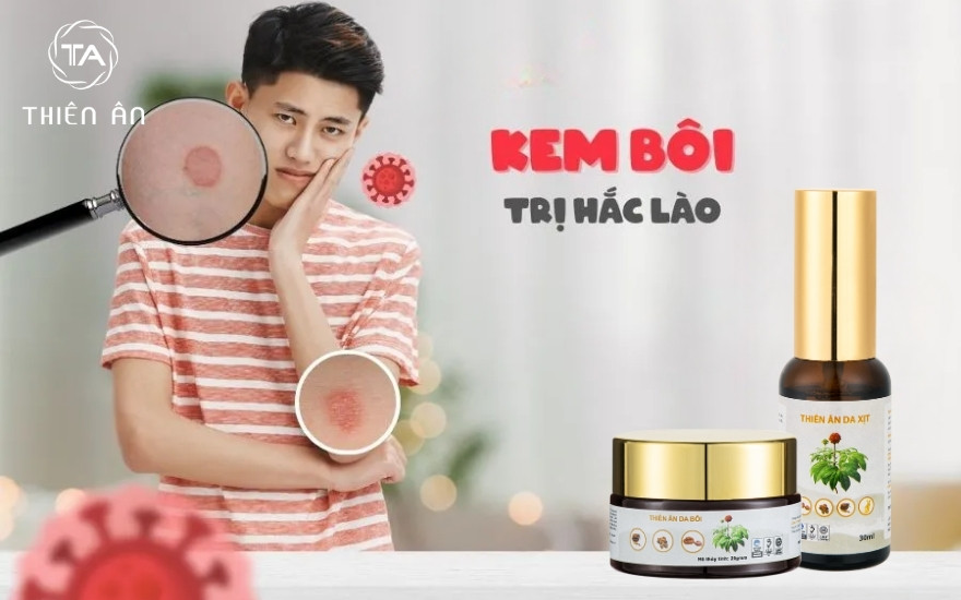 Bị hắc lào nên bôi thuốc gì