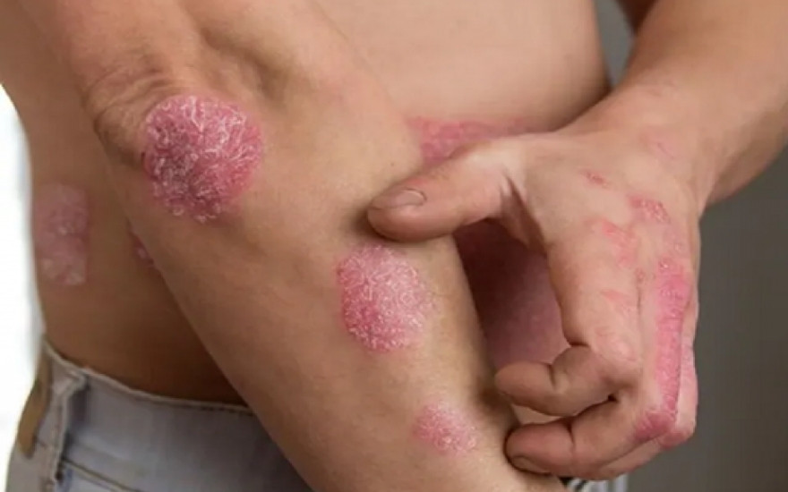 Bí quyết giúp chăm sóc da hắc lào đúng cách