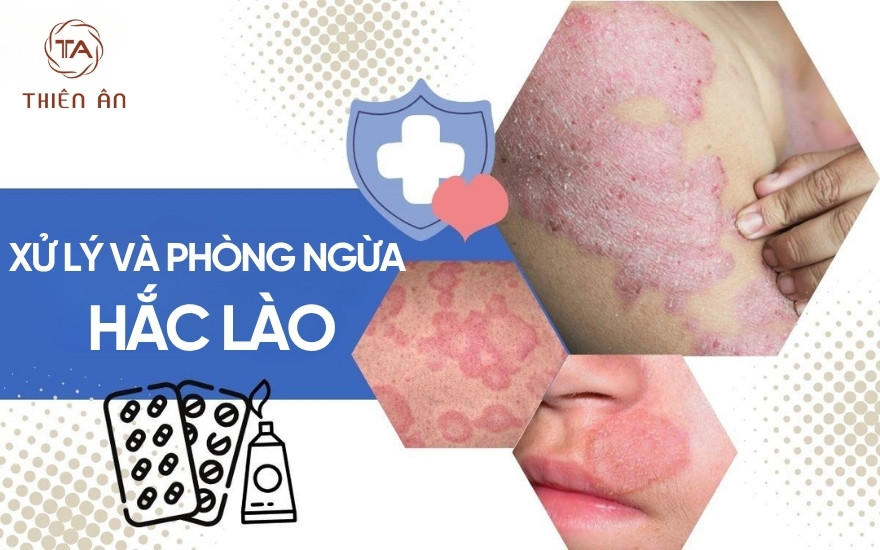 Các phương pháp xử lý và phòng ngừa bệnh hắc lào