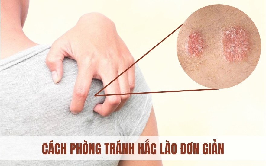 Cách chăm da để phòng tránh hắc lào