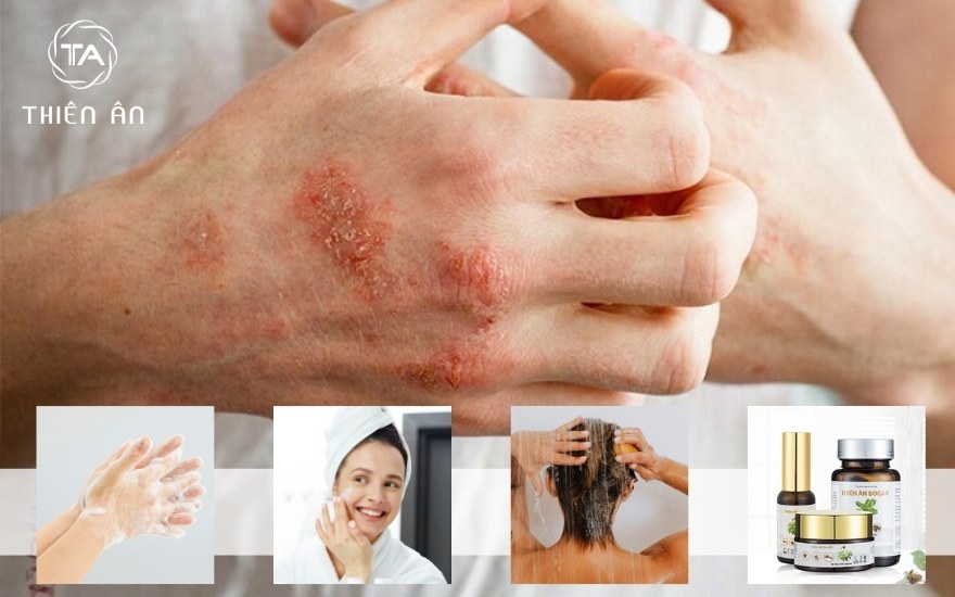 Cách chăm sóc và phục hồi da sau hắc lào