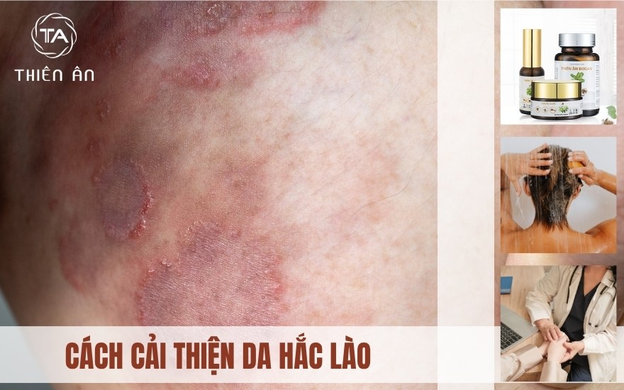 Cách giúp cải thiện da bị hắc lào