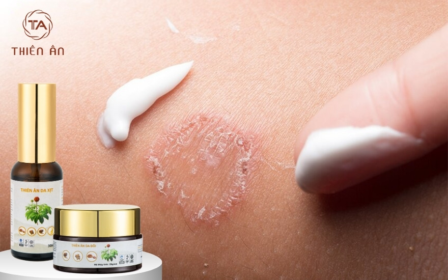 Cách phòng tránh bệnh hắc lào bằng sản phẩm phù hợp