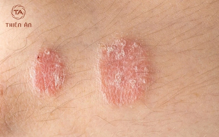 Dấu hiệu của bệnh hắc lào