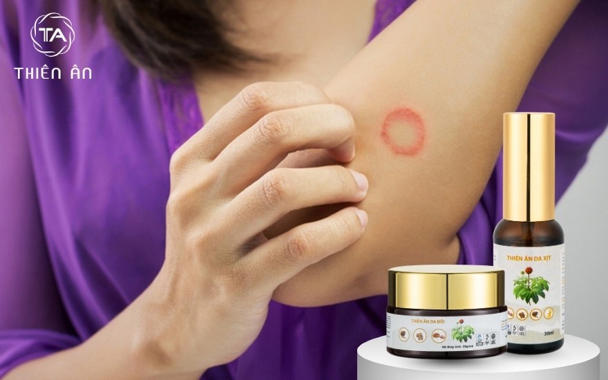 Giải pháp giúp xử lý hắc lào do nấm gây ra