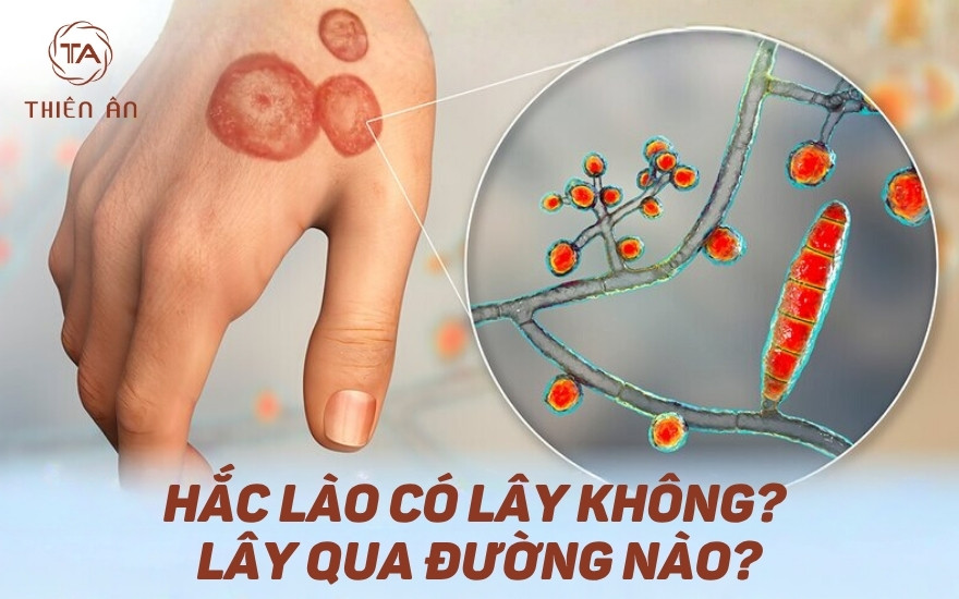 Hắc lào có lây không? Có đường lây bệnh nào?