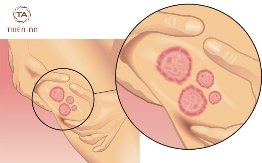 Hắc lào có lây không? Yếu tố làm tăng nguy cơ lây bệnh