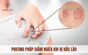 Hắc lào có ngứa không? Cách giải ngứa hiệu quả