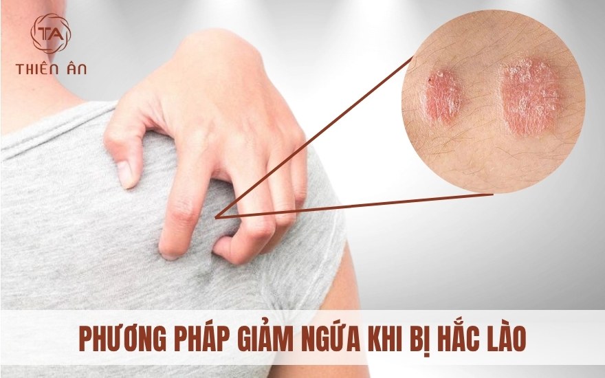 Hắc lào có ngứa không? Cách giải ngứa hiệu quả
