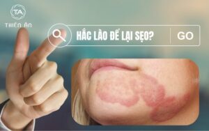 Hắc lào để lại sẹo không? Nguyên nhân là gì?