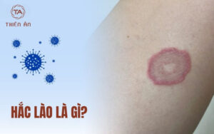 Hắc lào là gì?