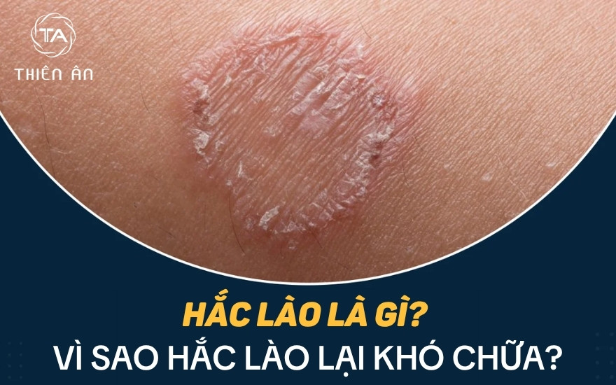 Hắc lào là gì? Vì sao khó chữa?