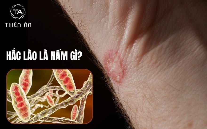 Hắc lào là nấm gì?