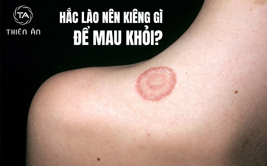 Hắc lào nên kiêng gì để mau khỏi