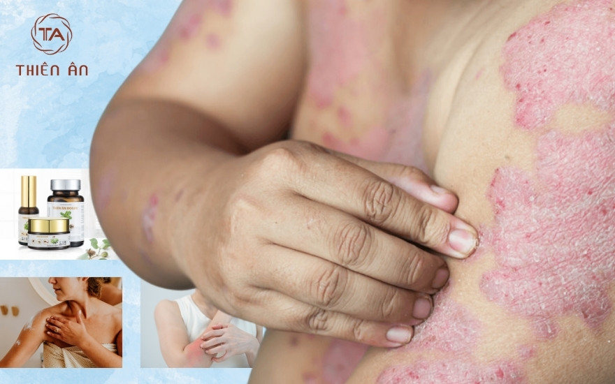 Kết hợp các cách chữa hắc lào giúp tối ưu hiệu quả