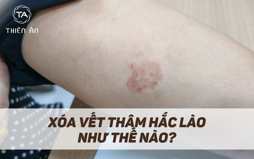 Làm cách nào để xoá vết thâm hắc lào