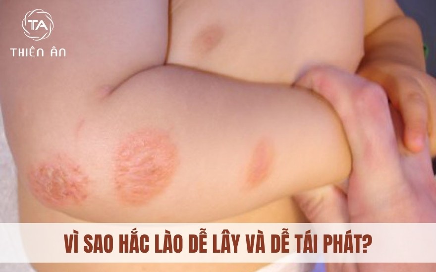 Nguyên nhân khiến hắc lào dễ lây lan