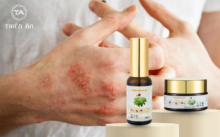 Thiên Ân - Đồng hành giúp cải thiện hắc lào