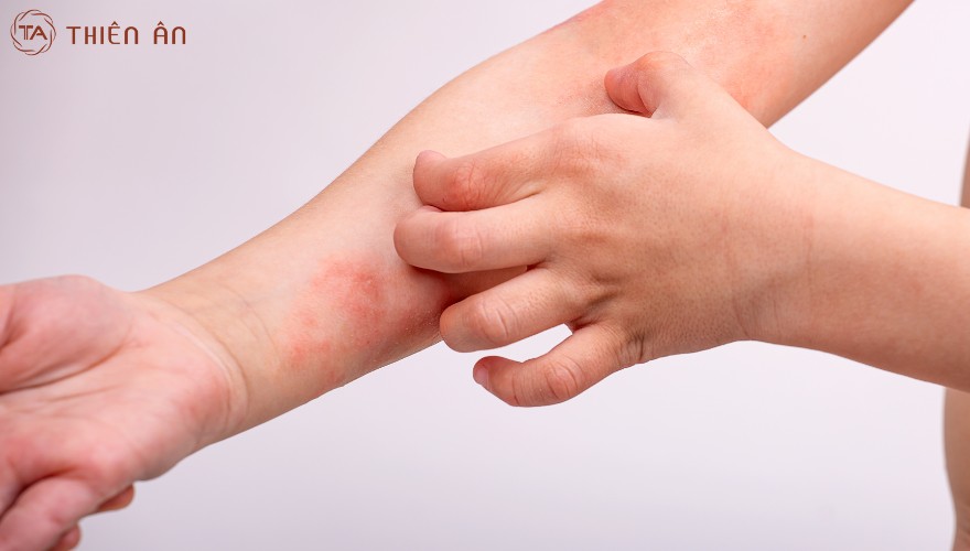 Thời tiết hanh khô dễ khiến tình trạng viêm da tái phát