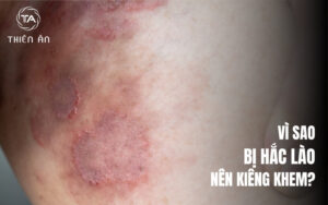 Vì sao người bị hắc lào nên kiêng khem