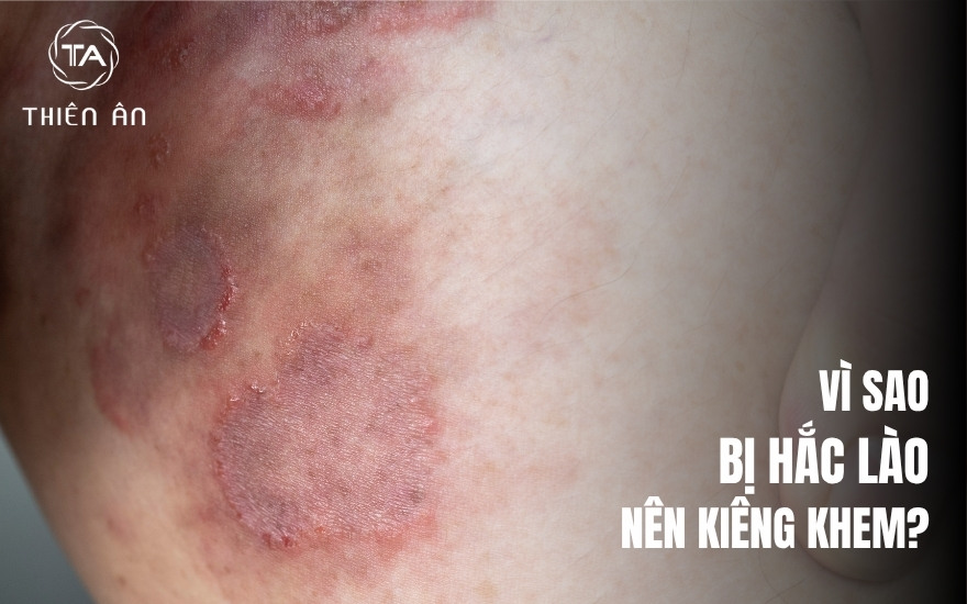 Vì sao người bị hắc lào nên kiêng khem